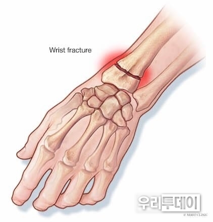손목골절 (손을 뻗어 땅을 짚으며 넘어지는 종목, 즉 사이클, 달리기 , 인라인 스케이팅, 스케이트보드 등에서 흔히 발생하며, 럭비나 미식축구처럼 손목에 직접적인 충격을 받거나 소목이 뒤틀릴 수 있는 종목에서도 이 부상이 자주 나타난다.)