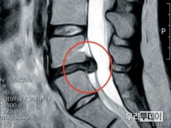 디스크가 탈출되어있다 (둥근원안)