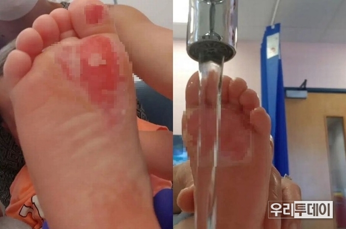 아이가 화상을 입은 뜨거운 주방 바닥과 아이의 발바닥 (사진=나타샤 페이스북 캡처)